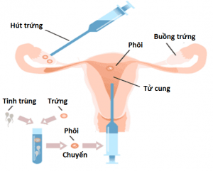 Điều trị vô sinh ở nam và nữ giới có những phương pháp nào?